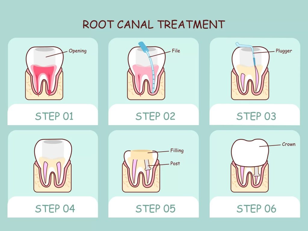 How Long Does A Root Canal Last Without A Crown