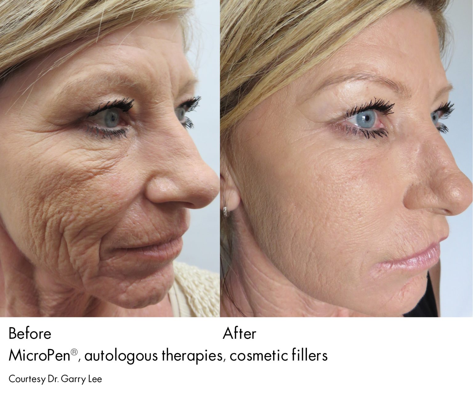 Microneedling With PRP Before After Real Patient Photos Results 