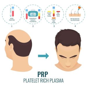 Understanding PRP Treatment Costs in 2024: A Comprehensive Guide - Chaztin