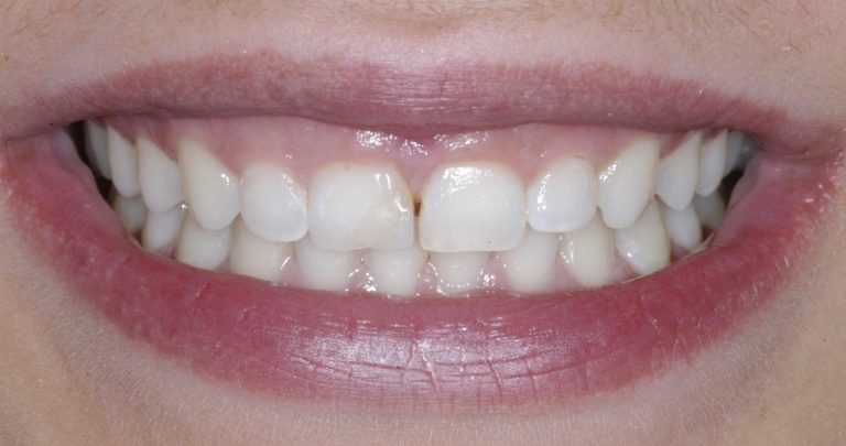 Teeth Lengthening: A Comprehensive Guide to Procedures, Costs ...