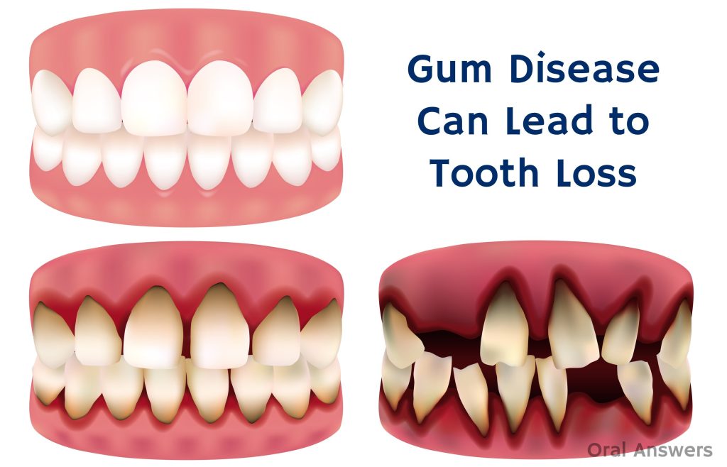 Tooth Is Loose But Still Attached Adults