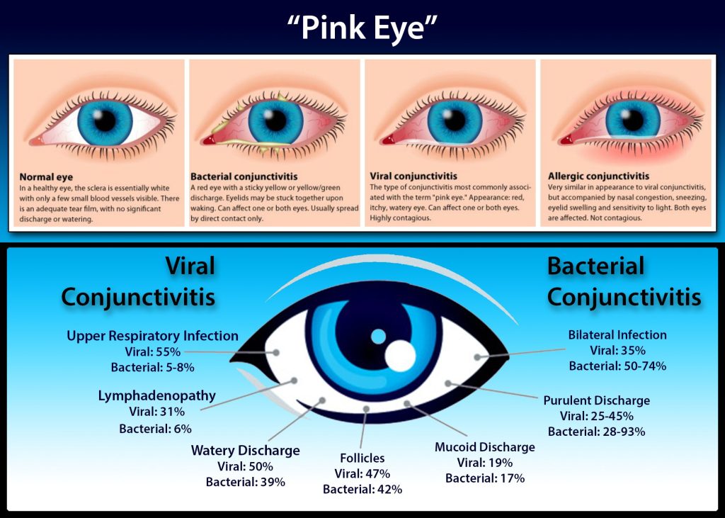 Amazing Can Pink Eye Be Caused By Sinus Infection Wallpaper in HD Amazing Can Pink Eye Be Caused By Sinus Infection Wallpaper in HD