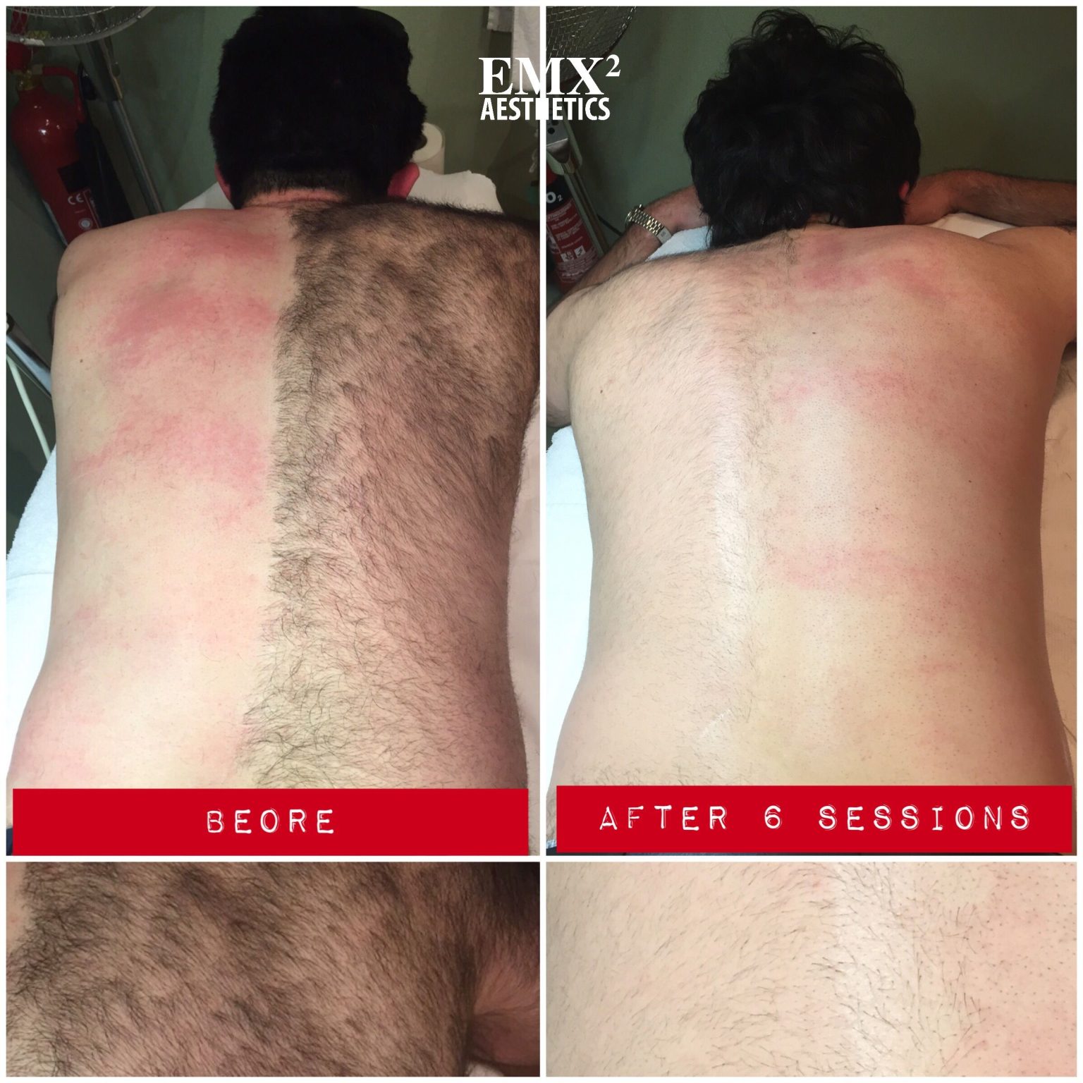 Full Brazilian Laser Hair Removal Stunning Before & After Photos & Transformation Results Chaztin