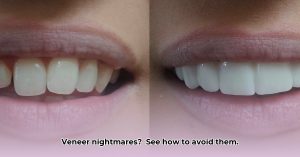 Bad Veneers Before & After: How to Avoid a Veneer Disaster - Chaztin
